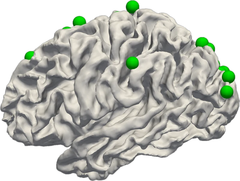 3-hinge gyral landmarks on a reconstructed cortical surface