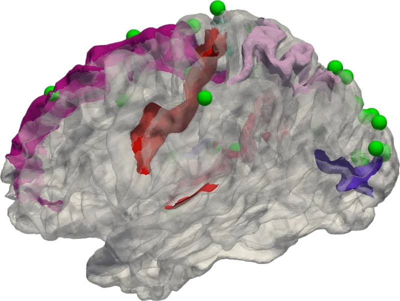 3HG landmarks together with atlas regions on the cortical surface
